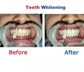 Before After 1