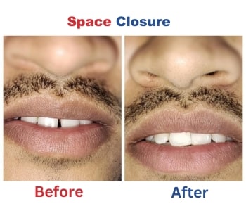 Before After 3