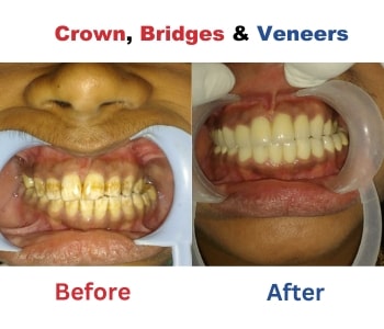 Before After 4